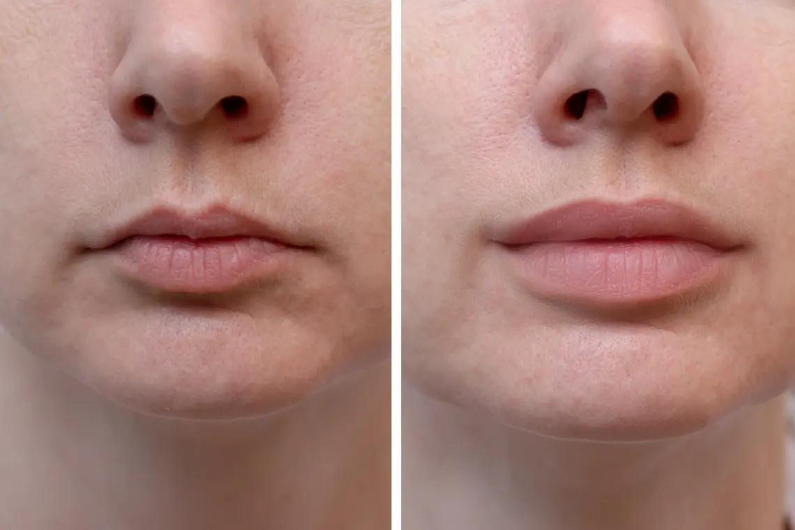 Botox Treatment