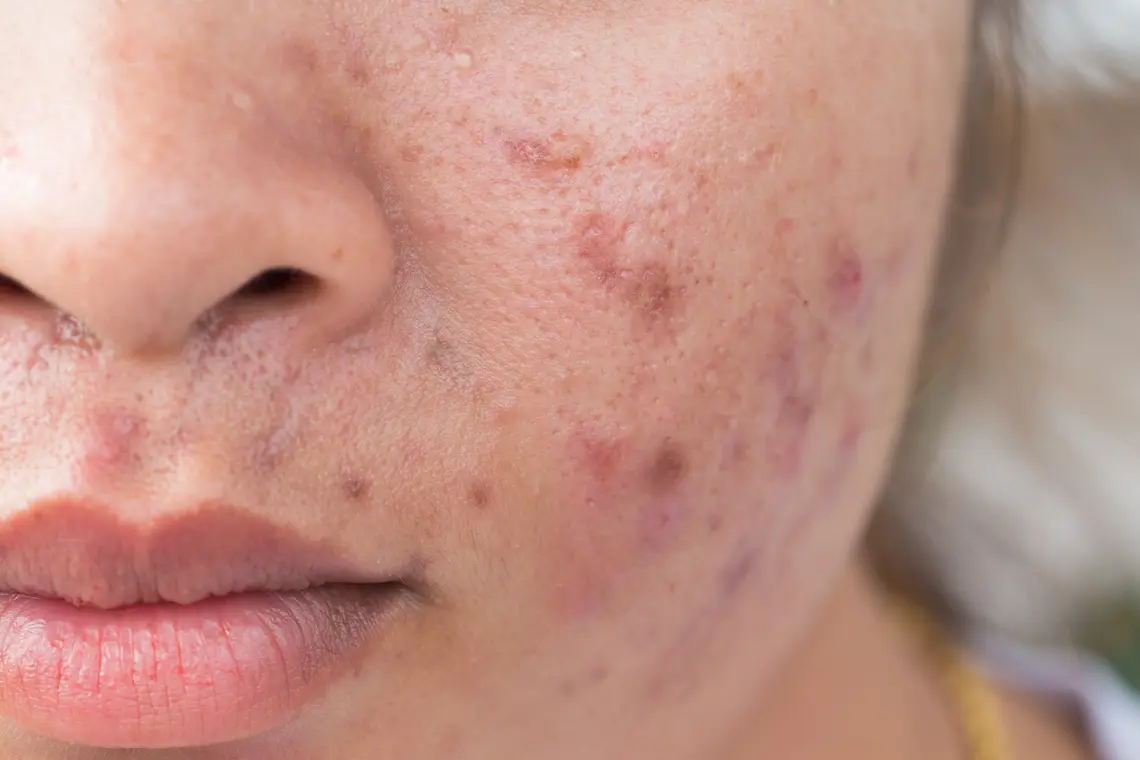 Acne scar treatment