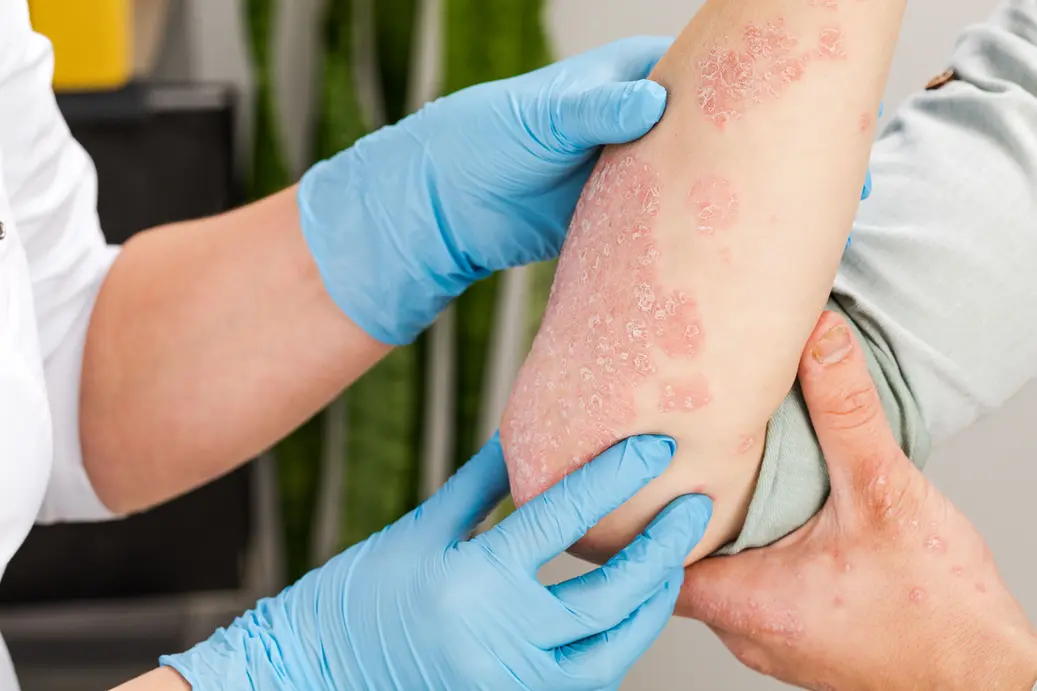 why early psoriasis treatment is crucial