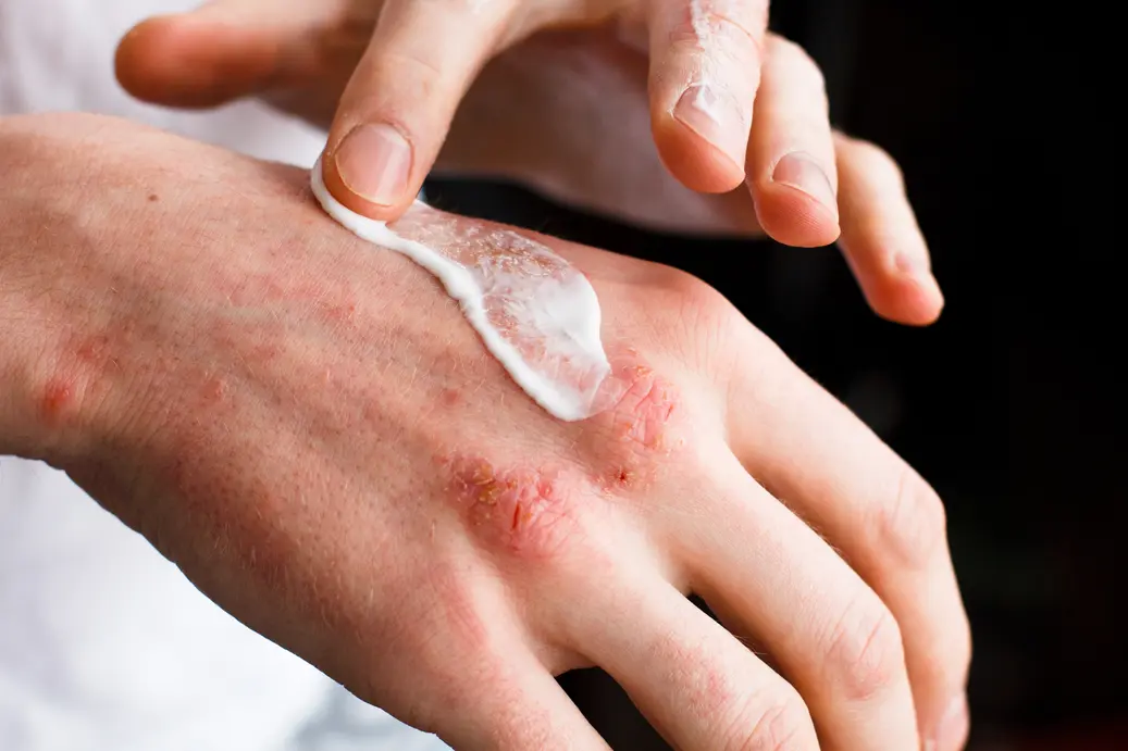 Psoriasis Treatment Option